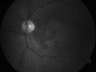 changes within central macula OU Pt notes