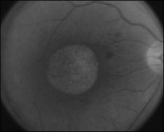 Clinical Case Full field flash ERG Normal rod response OU Severely reduced cone