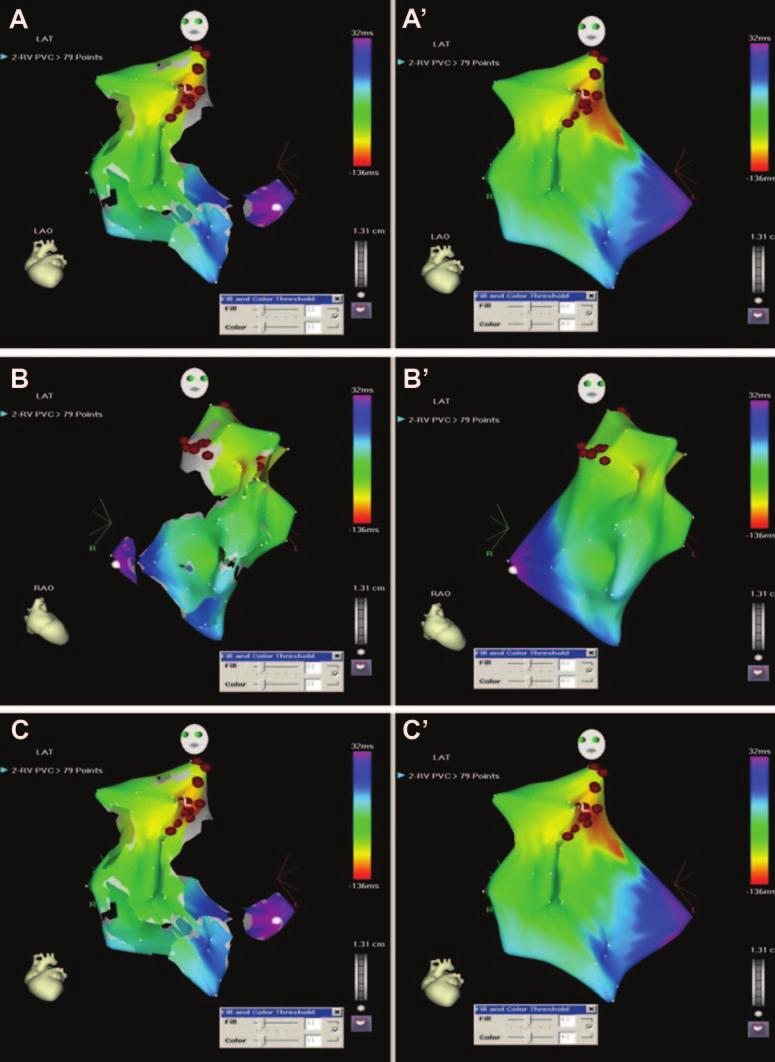 Munoz et al Teaching Points With 3D Mapping e9 Figure 3. Three-dimensional activation maps of a right ventricular focal ventricular tachycardia.