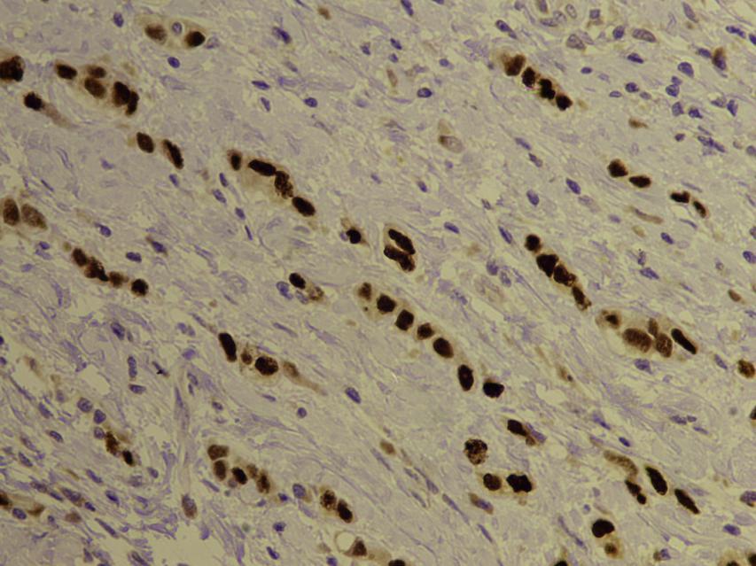 progesteronskih receptora (LSAB x 400) Slika 21.