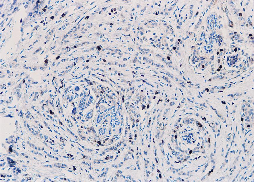 Ki-67 imunoreaktivnost jedara u invazivnim lobularnim karcinomima dojke različitih podtipova