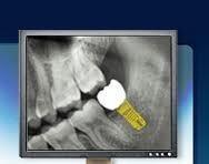 8- Dental Cones: - A tablet form intended