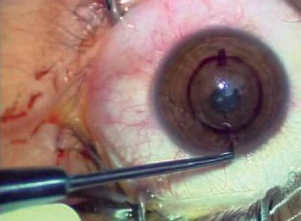 Initially, using a diamond knife, set at 90% of corneal thickness at 90 meridian, at 8 mm optic zone (Fig. 1A), a 0.