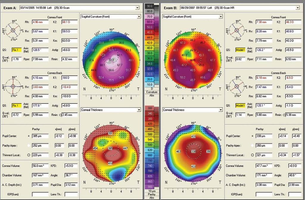 Average corneal pachymetry at the apex of the conus was 313 µ in the preoperative period and 493 µ postoperatively (p = 0.000). Preoperative UDVA was 20/400 and CDVA was 20/300.