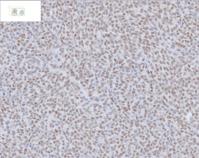 prostate cancer cells in SCID mice