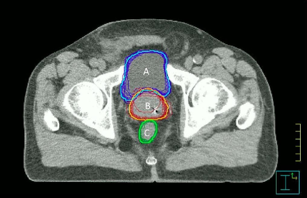 FIGURE 2: A representative central slice of the CT study with all observer contours superimposed FIGURE 3: An illustration of the