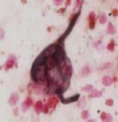 parkinsonism Gallyas silver stain Tufted astrocyte in basal ganglia Globose NFT in S.