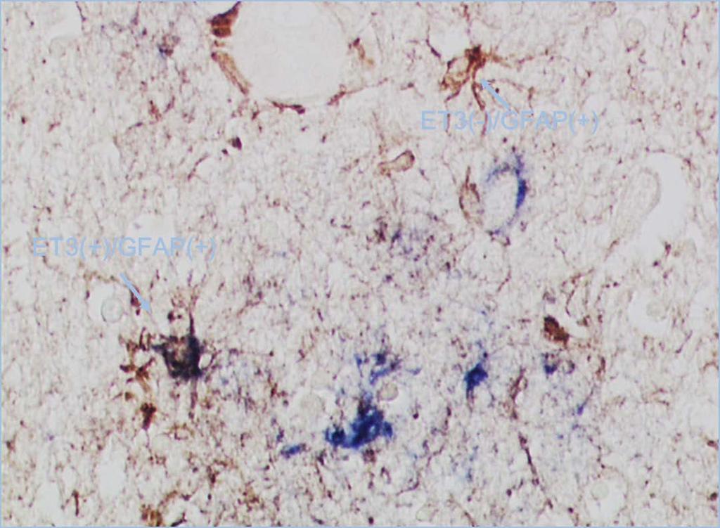 Double immunostain for 4R tau and