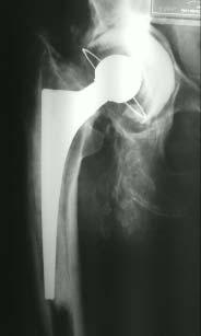 - periprostetic bone fracture (injury) -