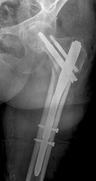 fracture fixation