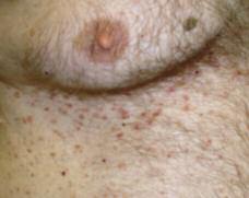Case 2 An Itchy Midriff This 60-year-old male has been periodically troubled by intensely itchy papules on his midriff. a. Grover s disease (transient acantholytic dermatosis) b. Scabies c.