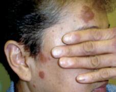 Case 5x A Historic Disease This 58-year-old woman grew up in Southeast Asia. Over the past three years she has noticed the appearance of lesions on her arms, fingers, legs and face.