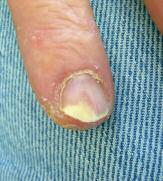Case 7 White-Translucent Nail Plates A 47-year-old male oil rig worker, with past medical history of psoriasis, presents with an increasing white-translucent area on the distal nail-plate of several