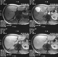Top left, T1-weighted MRI demonstrates an ill-defined low-signalintensity mass.