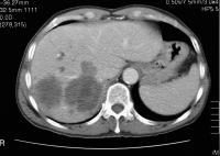Contrast-enhanced CT scan in a