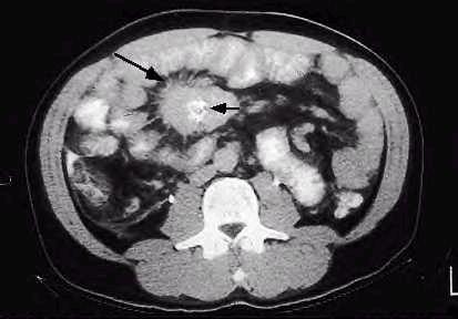 CT Scan Small Bowel Carcinoid