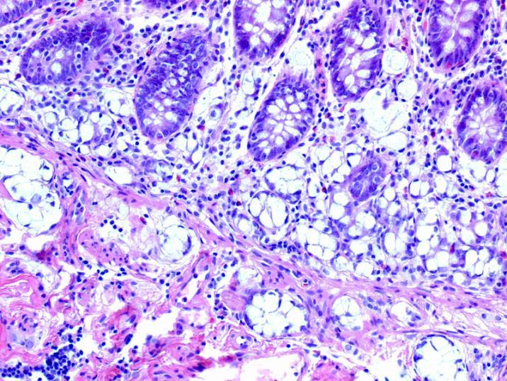 Adenocarcinoids (aka goblet cell carcinoid, mucinous carcinoid) Mixed tumors May stain for chromogranin A Usually appendiceal origin Can be aggressive Distant mets