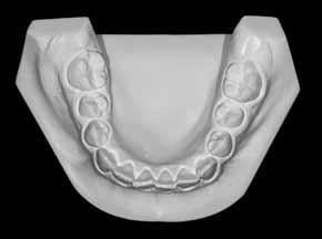 In this case, the smile line inclination was mainly due to: 1) the inclination of the upper left central incisor; and 2) to the infraocclusion of the upper left canine, semi-impacted, rather than to