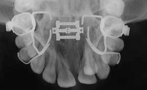 fter upper arch leveling, the upper left canine would be distalized using a compression coil spring. The eventual need for an upper frenectomy was also included in the treatment plan. fter the 0.