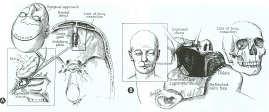 Craniofacial Resection Currently Entire Skull Base Accessible to Open Approaches Multiple Approaches Skull Base Region