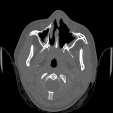 Corridors: Trans-cribiform Corridors: Trans-clival 49 50 Cranio Cervical Junction Endo-Nasal Endo-Oral Lateral Corridor Endoscopic Anterior Maxillotomy Transnasal