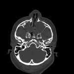 Lateral Skull Base Maxillary Sinus Lateral Corridor