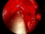 canine fossa 61 62 Address Posterior Maxillary Sinus Lesion