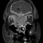 5 6 And Intracranial