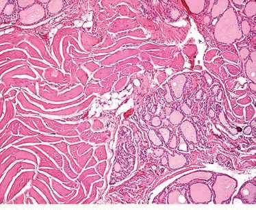 Pseudoinfiltration of skeletal muscle by benign thyroid tissue At the periphery of the thyroid gland, there is a close anatomical relationship between the outermost thyroid follicles and