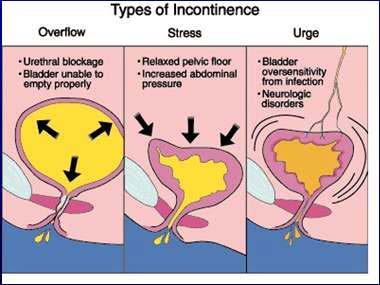 Types of Incontinence Seen After Radical Prostatectomy Stress Involuntary urinary leakage on effort or exertion, sneezing, or coughing Urge Involuntary leakage accompanied by or immediately preceded