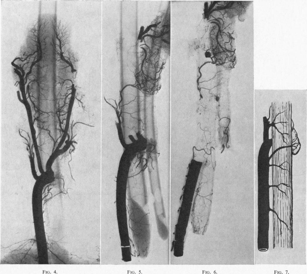 134 J. LISTER FIG. 4. FIG. 5. FIG. 6. FIG. 7. FIG. 4.-Specimen showing oesophageal vessel arising direct from FIG. 5.-Radiograph of specimen showing bronchial artery crossing innominate artery.