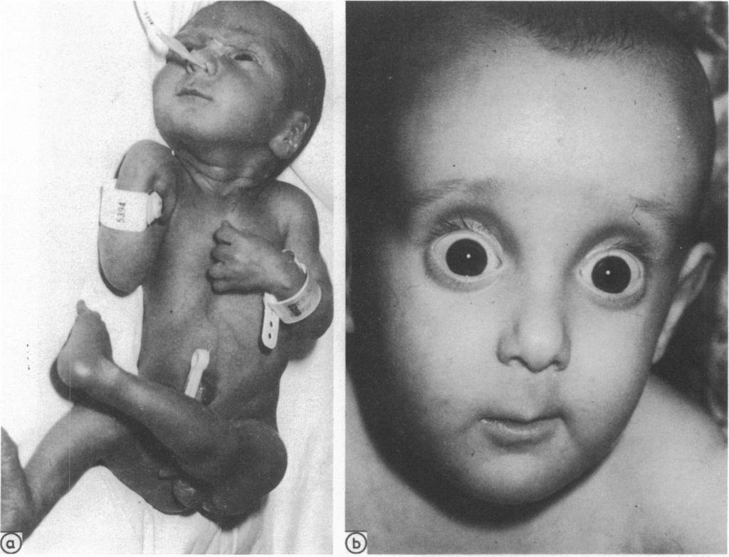 . Case 3 at 34 weeks old when appearance is not diagnostic showing only thin skin and somewhat long feet similar to Clinical presentations of Ehlers Danlos syndrome type IV 1019 Fig 3a fig 2.