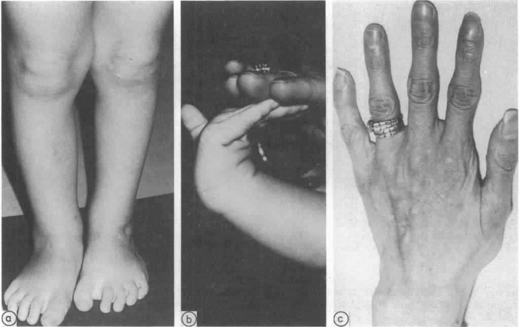ol (IIl)-.' Clinical presentations of Ehlers Danlos syndrome type IV 1021 Broadfeet and loose jointed hands of case 4. Fig 5c Acrogeric hands ofmother of case 4.