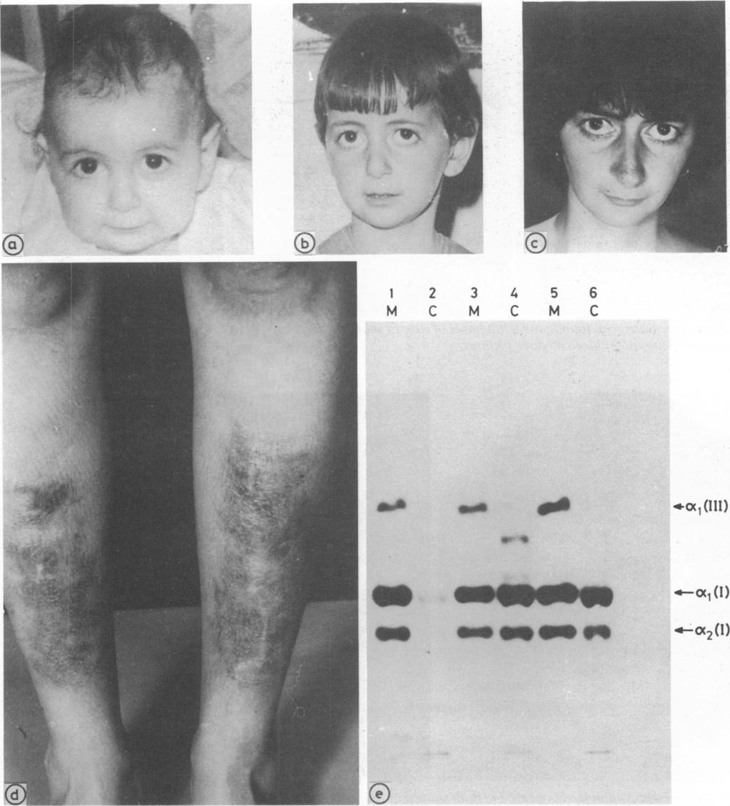 - Clinical presentations of Ehlers Danlos syndrome type IV 1023 1 2 3 4 5 6 M C M C M C a. -.Oc, (111) a.~~~~~~~~~~~~~~~~~~~~~~~~~~~~~ *- (1) a*-c2(1) Arch Dis Child: first published as 10.1136/adc.