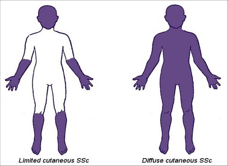 Systemic sclerosis () A heterogeneous, severe rheumatic connective tissue disease 1 in 1, affected, Female predominance - 4:1 Complex pathogenesis: infection agents, environmental triggers and