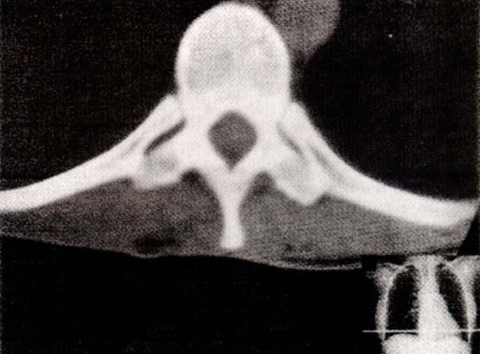 CT OF THORACIC VERTEBRA body of Vertebra T10 rib rib transverse process spine Note: In radiographic