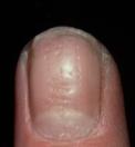 depressions in nail surface Onycholysis separation of distal nail from nail bed white / yellow discoloration of distal nail