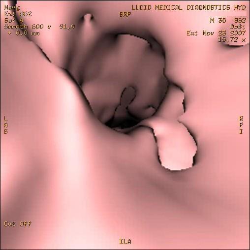 Method 3D MRCP was carried out on a 1.5T HDx GE MR (General Electric, Milwaukee, WI, USA) machine with the following parameters: TR- 3750