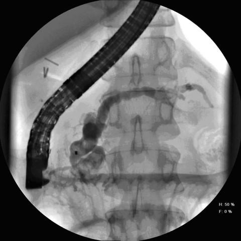 ESWL followed by ERCP was performed with main pancreatic duct clearance (Figure 2;