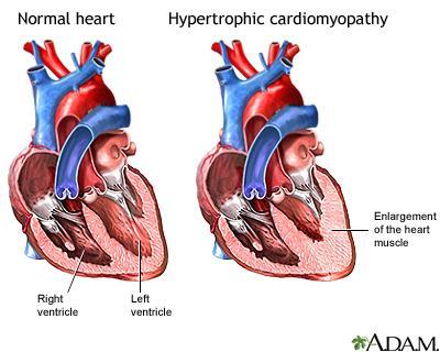 Hyperinsulinism and Pregnancy Hypertrophic myocardiopathy: hypertrophy of the septum and ventricular walls that can in some cases obstruct blood flow. https://ufhealth.