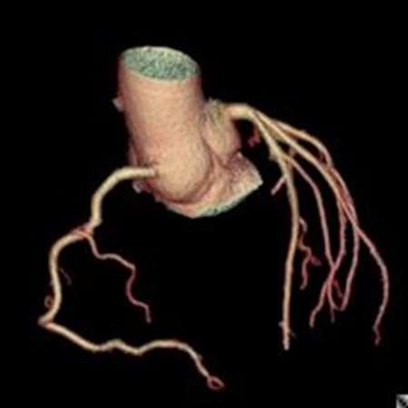 CT angiography provides high