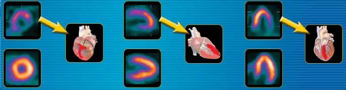 What do MPI images look like? - Summed Perfusion Images Summed images are used to assess cardiac perfusion.