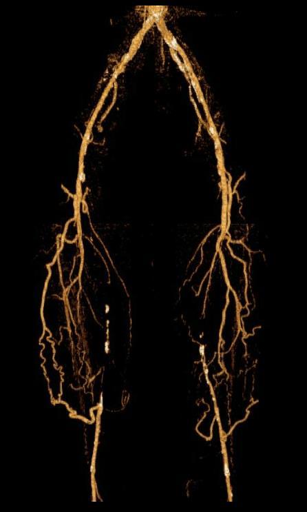 Computed Tomographic Angiography (CTA) Requires iodinated contrast