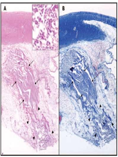 PNI Histology Bunch et al, JCE 2005;16:1318-25 Thermal injury including edema,