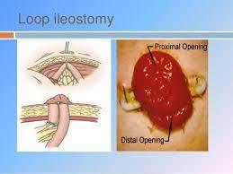 Loop Stoma This is often used for diversion.