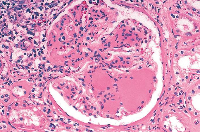 Diabetic nephropathy, nodular glomerulosclerosis Ball-like deposits of a laminated matrix situated in the periphery of the glomerulus
