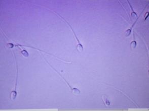 Treatment of abnormal DNA fragmentation in sperm Digital High Mag IMSI Sperm Selection
