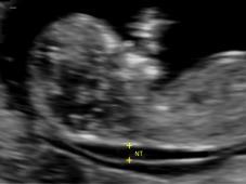 Current prenatal testing Non-invasive prenatal