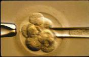 Embryo biopsy This embryo NOT suitable for transfer. Multiple chromosomal abnormalities.