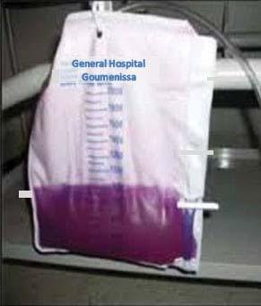 PATHOGENESIS Rarely, there can be purple discoloration of the urine (the purple urine bag syndrome) The purple